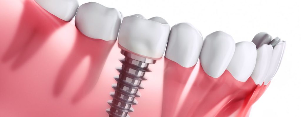 Role of Dental Implants in Restoring Your Smile