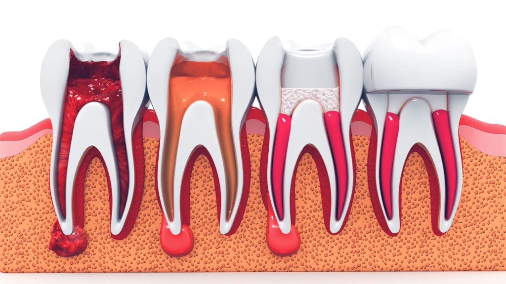 Root Canal Treatment in Gisborne
